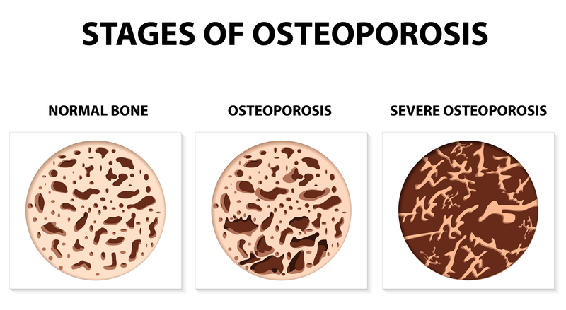 osteoporosis-indianapolis-indiana